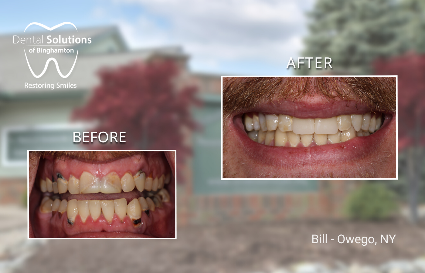 Implant Gallery Serving Broome, Tompkins & Tioga Counties